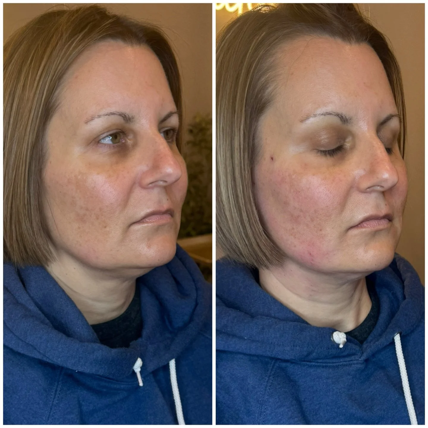 ✨A subtle lift with real structure.

🧵PDO threads are designed to reposition and support the skin, not add volume.. making them perfect for areas where heaviness or laxity is starting to show.

In her before &rarr; after, you can see:
&bull; Lift th