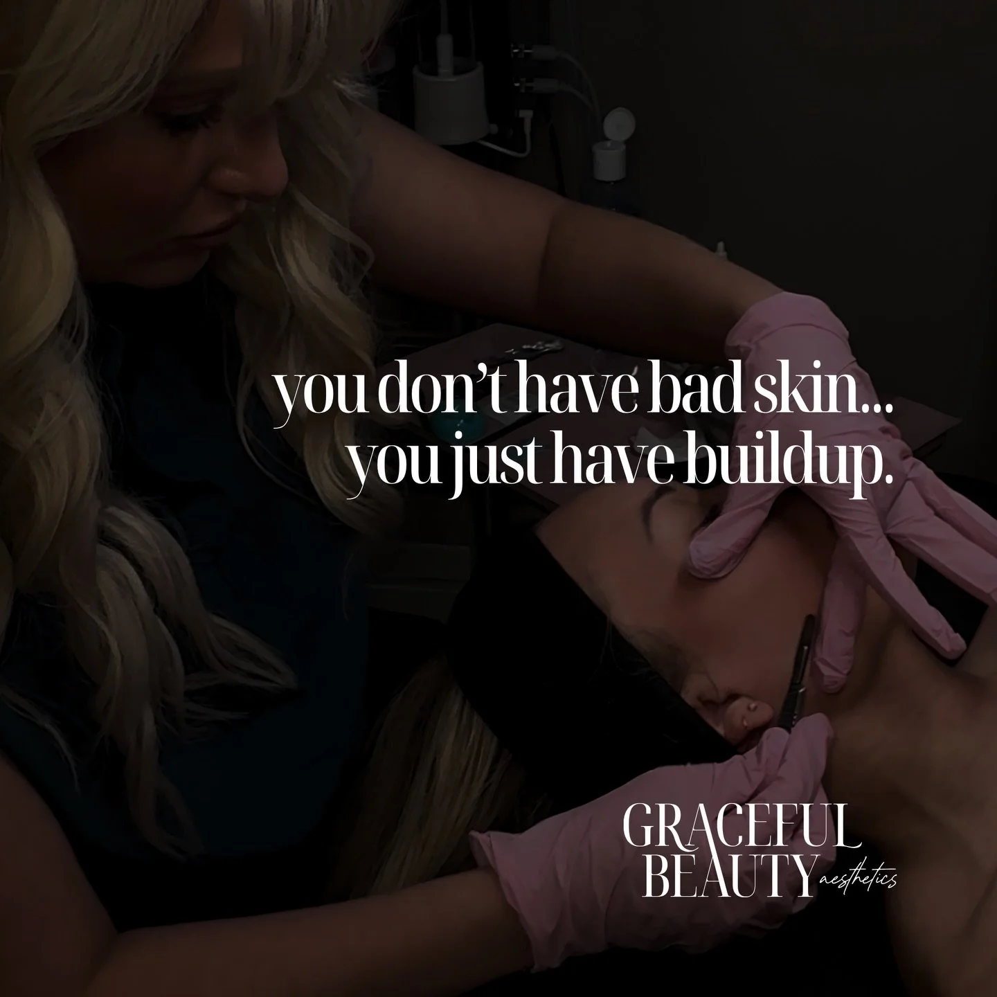 Let&rsquo;s be honest&hellip;
half the time it&rsquo;s not your products 👀

It&rsquo;s the layer of dead skin + peach fuzz sitting on top of your skin blocking everything from doing its job.

Dermaplaning is one of the easiest ways to:
smooth your s