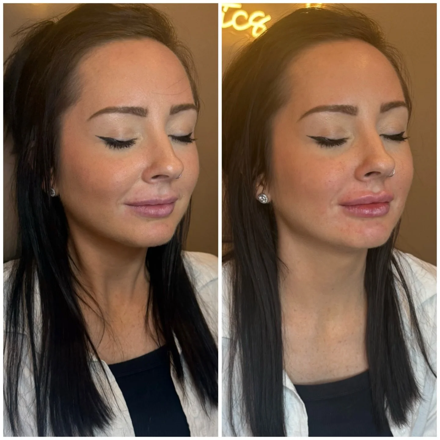 💉 We kept this one super intentional.. enhancing her natural shape, adding subtle volume, and bringing balance to both the top and bottom lip without overfilling.

You can see a smoother border, better symmetry, and that soft, hydrated plump that st