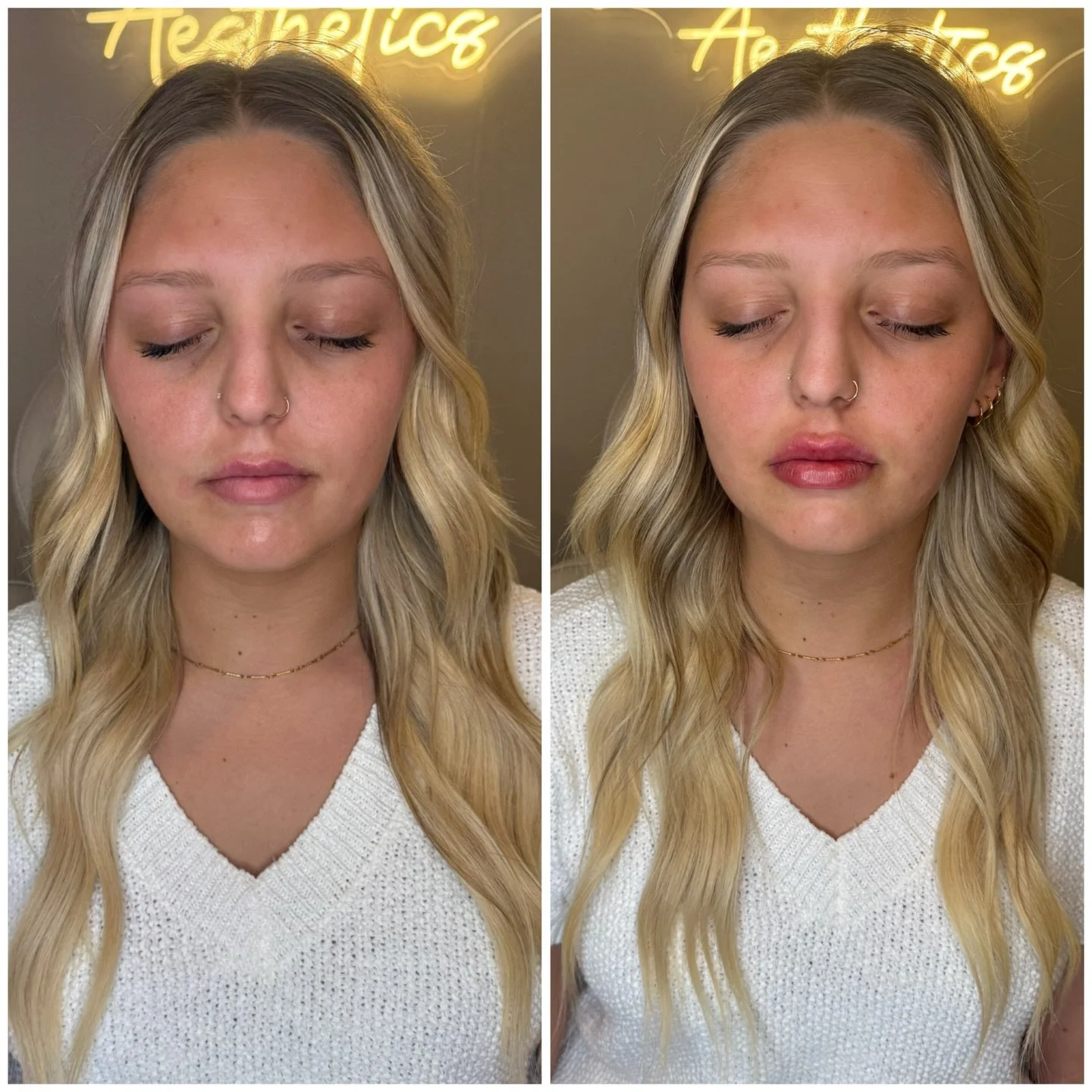 A little refresh goes a long way 💋

💉Lip filler touch-ups keep your shape, structure and balance exactly where you want it&mdash;no starting over, just maintaining the look you love. 

April Lip Filler Specials:
&frac12; Syringe $300 ($50 off) 💋 
