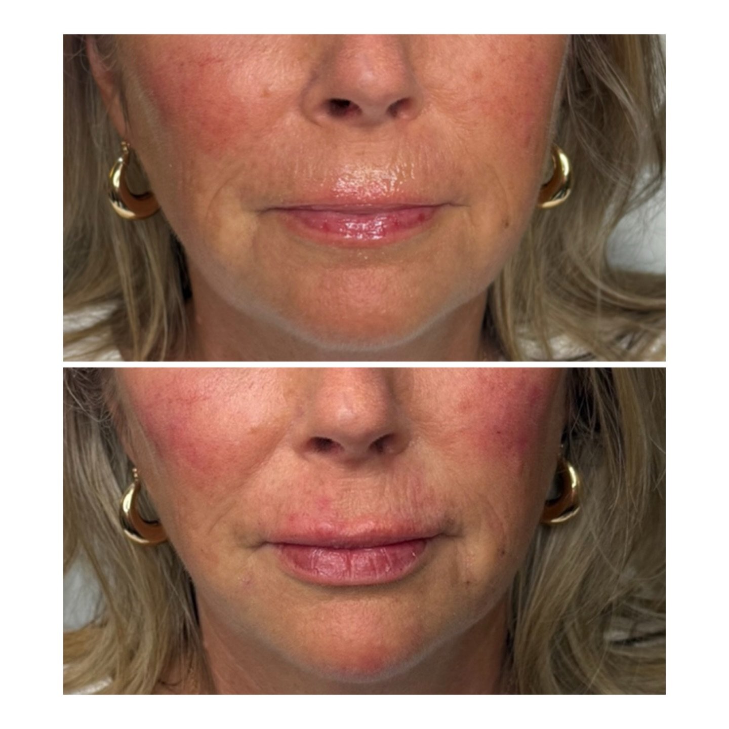 This is what full facial balancing can look like.✨

Strategic placement in the cheeks, chin, pre-jowl sulcus, lips and around the mouth to soften lines and restore structure &mdash; not to change her, just to refresh her.

The goal is always harmony&