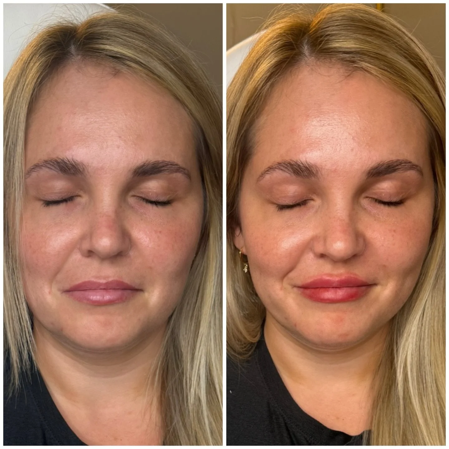 Subtle, balanced, and built for her features 🤍

A little lip filler can go a long way &mdash; restoring shape, enhancing symmetry, and adding just enough volume without looking overdone.

Swelling is normal right after treatment, with final results 