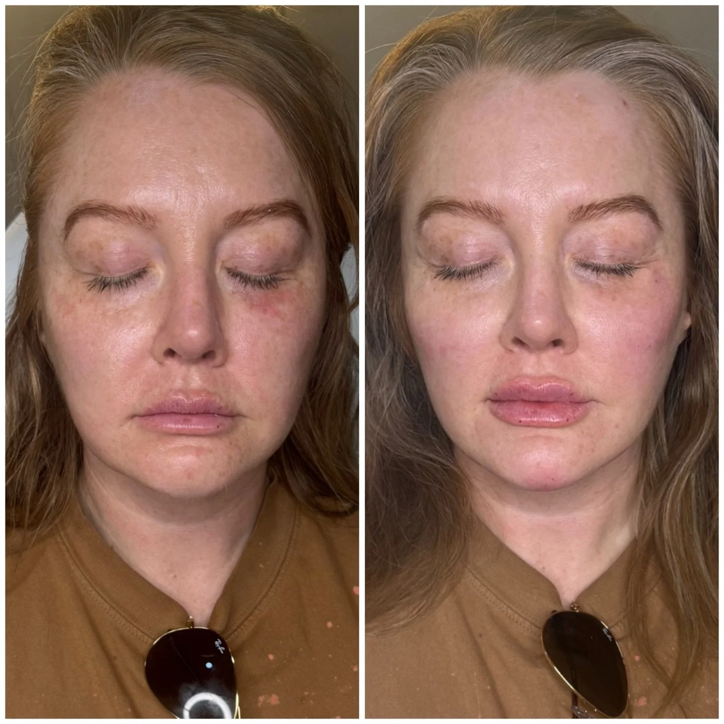 Full face, thoughtfully balanced.✨

Cheeks, chin, jawline, lips, and a touch through the nasolabial folds + marionette lines. All working together to restore structure, improve symmetry and soften overall appearance.

This is the power of treating th