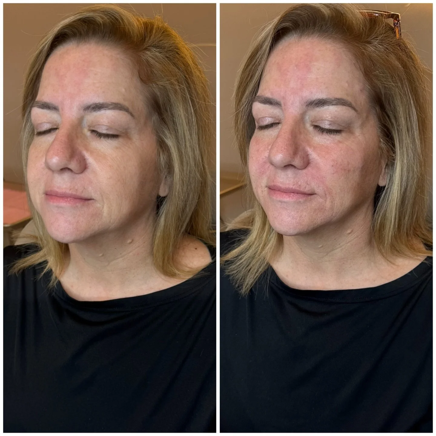 Subtle shifts. Major impact.

Facial balancing isn&rsquo;t about changing someone&rsquo;s face&mdash;it&rsquo;s about restoring proportion and support where it&rsquo;s been lost over time. By strategically treating the midface and lower face, we can 