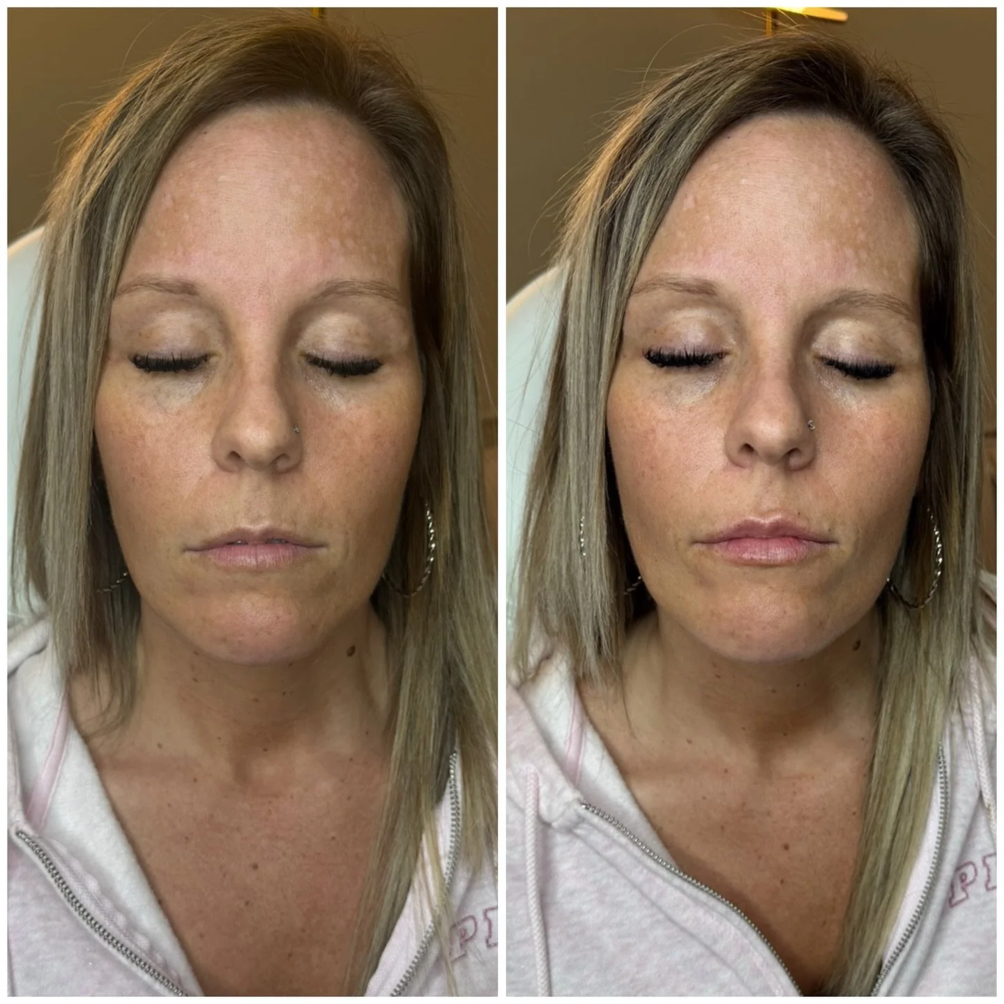 This is your reminder that you don&rsquo;t need a full syringe to see a beautiful result&hellip; sometimes less really is more 💉

Our April lip special:
&bull; Half syringe $300
&bull; Full syringe $600

Perfect for first-timers or anyone wanting a 