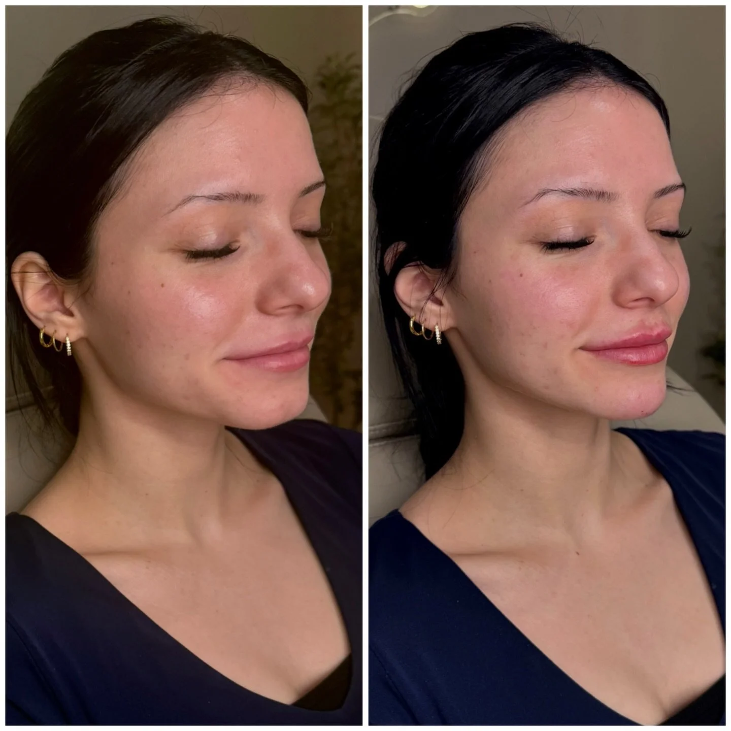 Lip + chin filler .. the underrated duo💉

A lot of people think lips alone will balance the face&hellip; but the chin plays a huge role in overall harmony.

By adding subtle projection to the chin + a little volume to the lips, we can:
&bull; improv