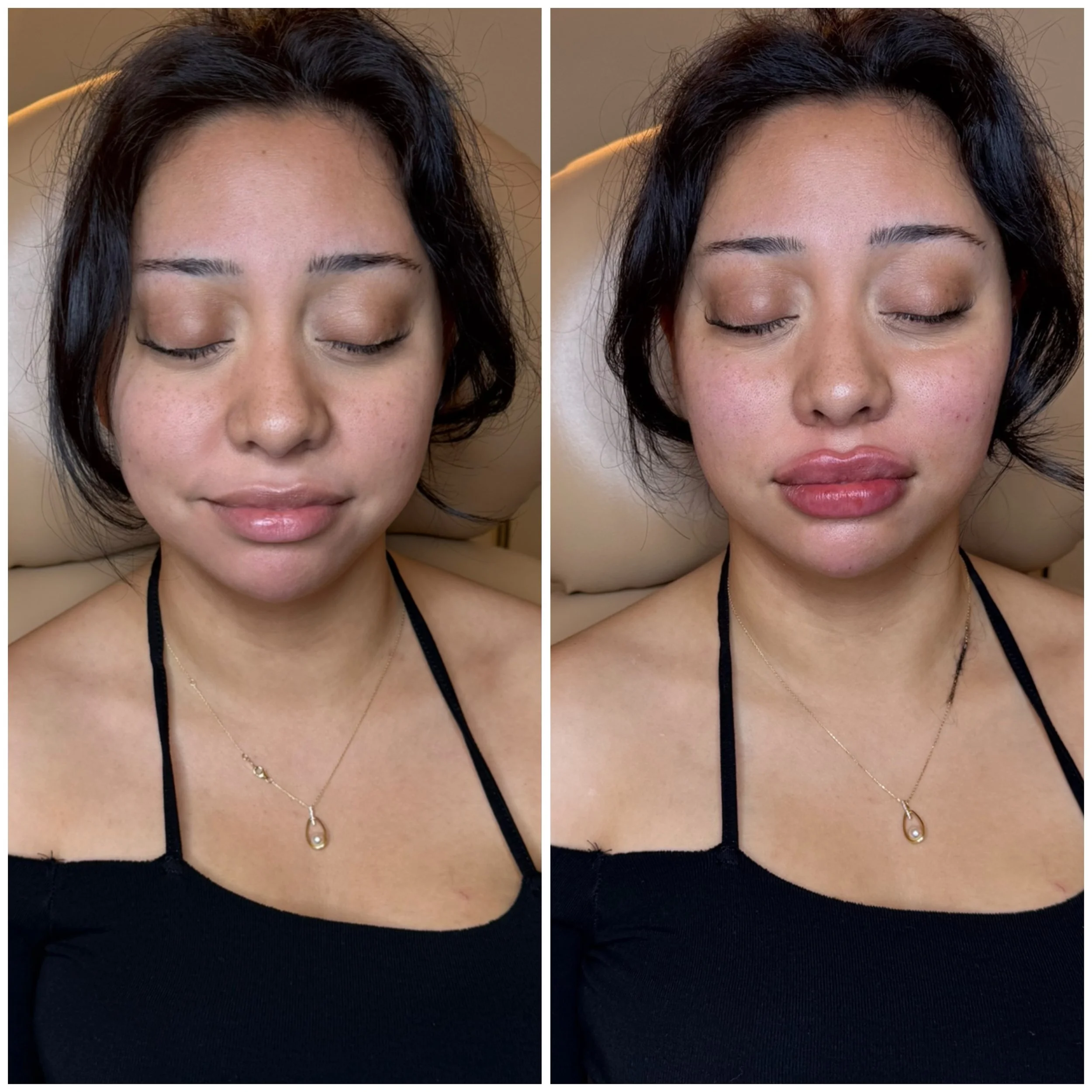 Obsessed is an understatement!🔥

This is what happens when we don&rsquo;t just &ldquo;add volume&rdquo;&hellip; we build structure.💉

In her before &rarr; you can see everything is a little softer and sits lower.
In her after &rarr; look at how eve