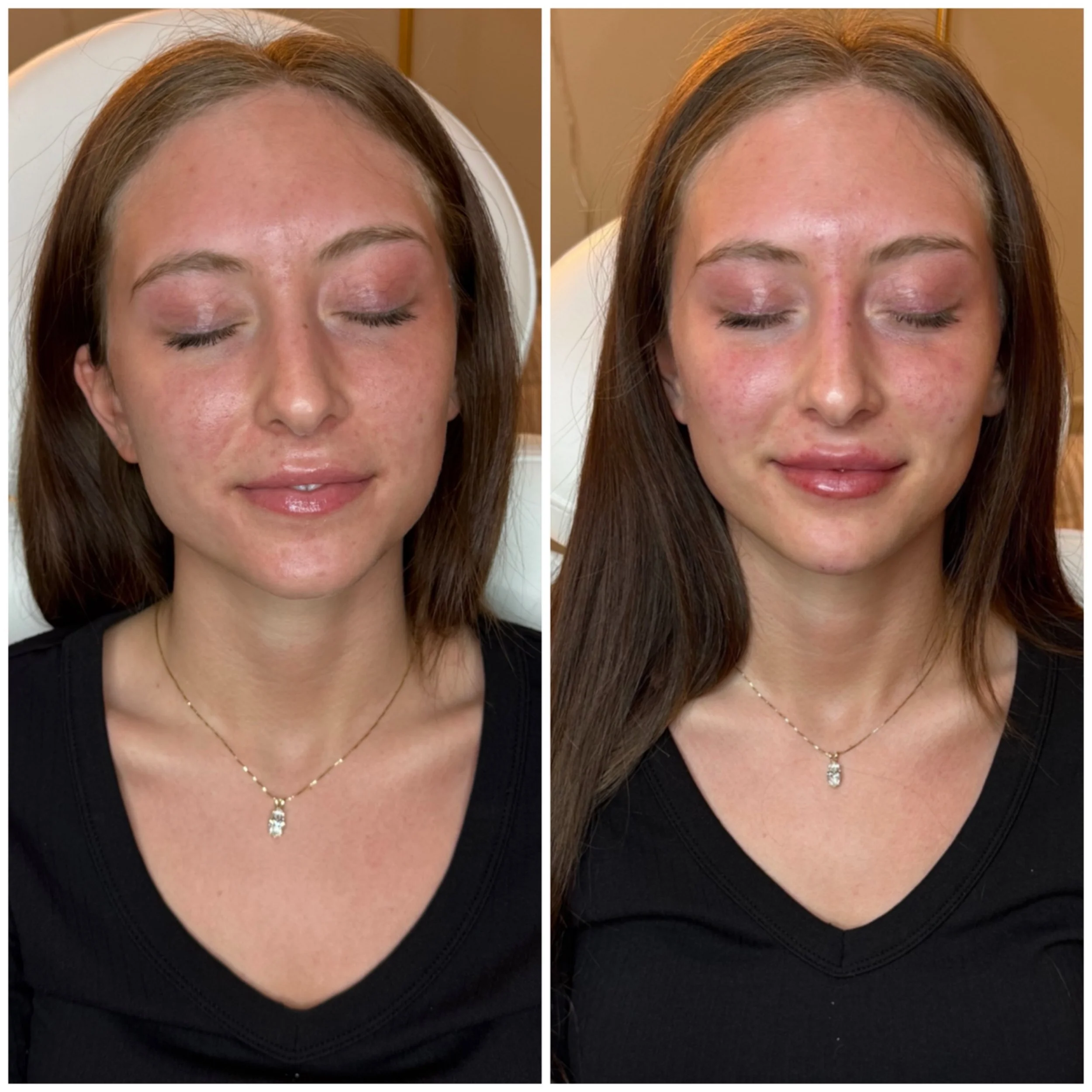 A little filler in the cheeks for lift,

A little in the chin for structure + profile balance, 

A touch in the lips to tie everything together! 💉 

Swelling is expected right after treatment (especially in the lips), so her final results will softe