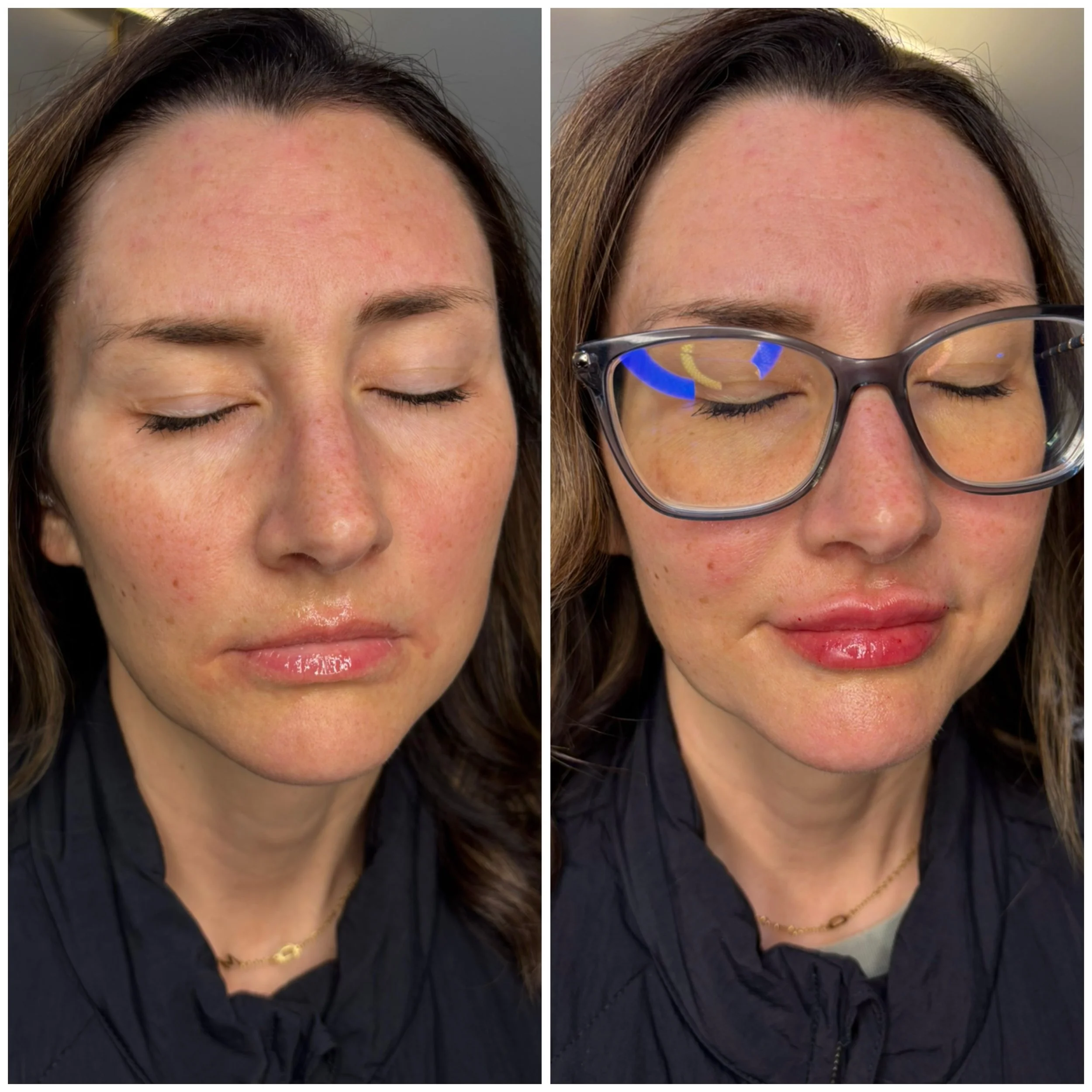 A subtle lip enhancement can soften the entire lower face, add hydration and definition, and create better balance without looking overfilled 👏🏼

Injector: Michele 💉

Notice in the after:
&bull; improved shape + border definition
&bull; more suppo