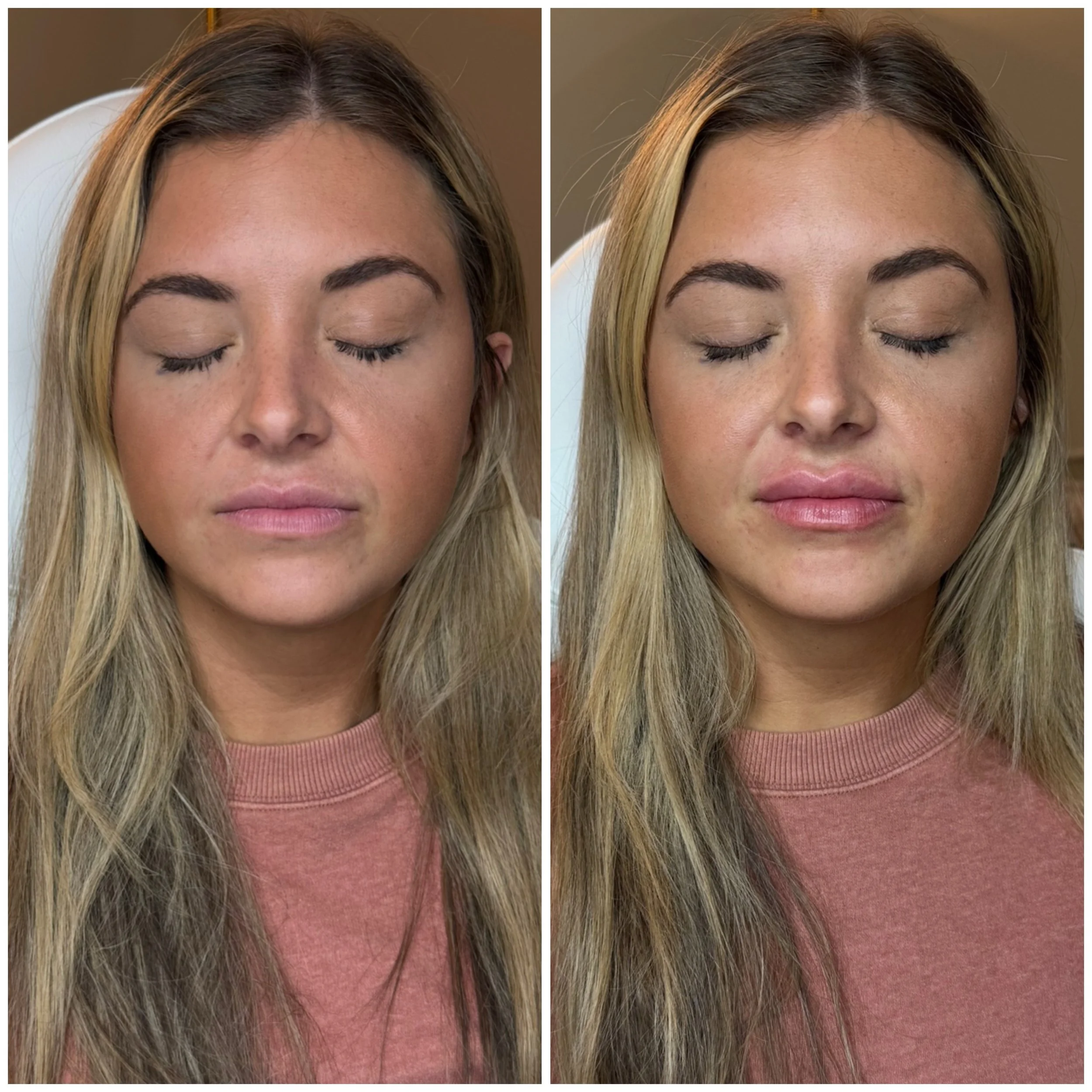 POV: your lips still look like your lips&hellip; just better 💋

A subtle enhancement can make such a huge difference in overall facial balance. We added soft volume, a little more shape, and improved hydration while still keeping everything natural 