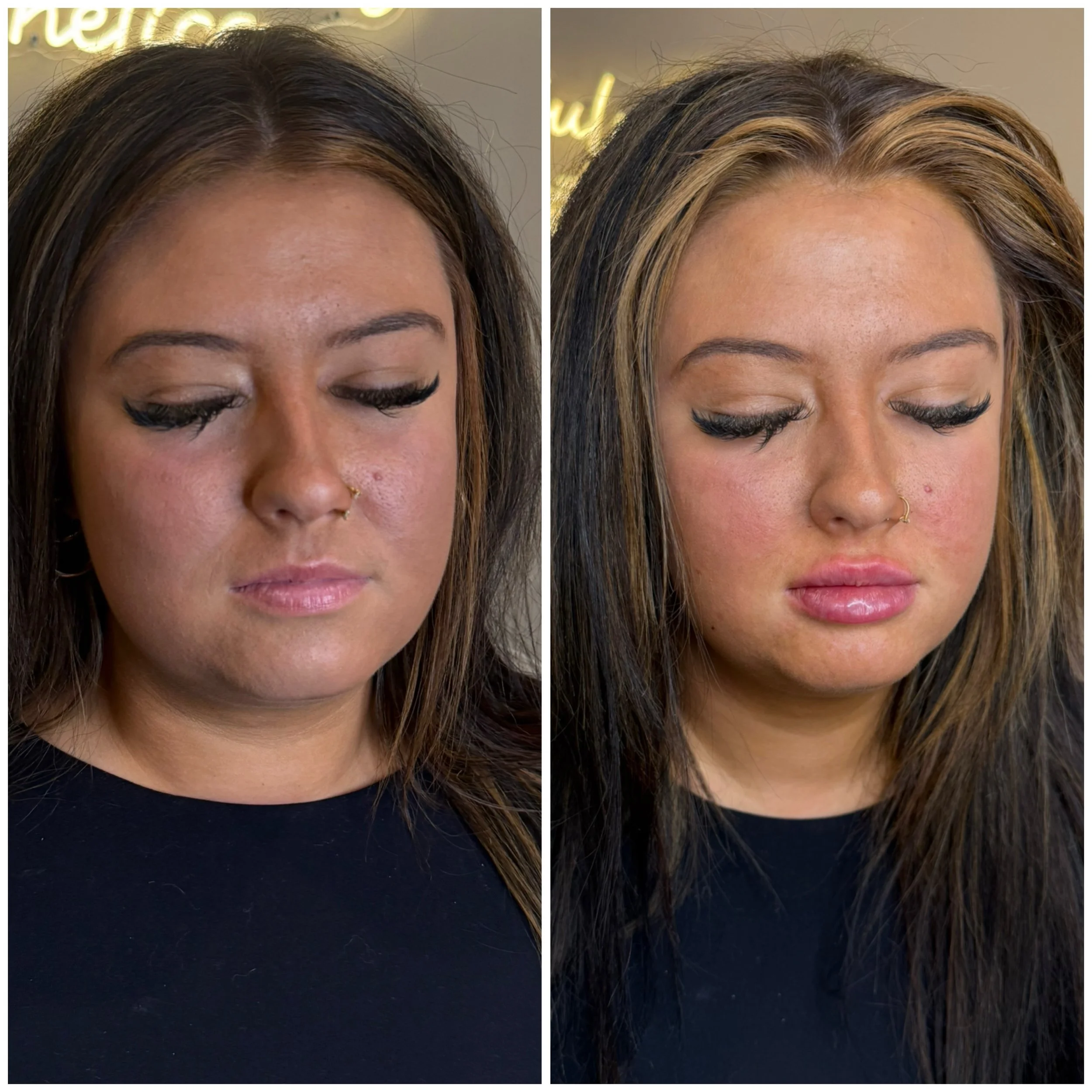 Fresh lip filler will always have some swelling immediately after treatment, so results will continue to soften and settle over the next 2 weeks.

Lips by Brittany 🖤

📍 Mansfield + Findlay, Ohio
📲 DM us or visit our website to schedule your consul