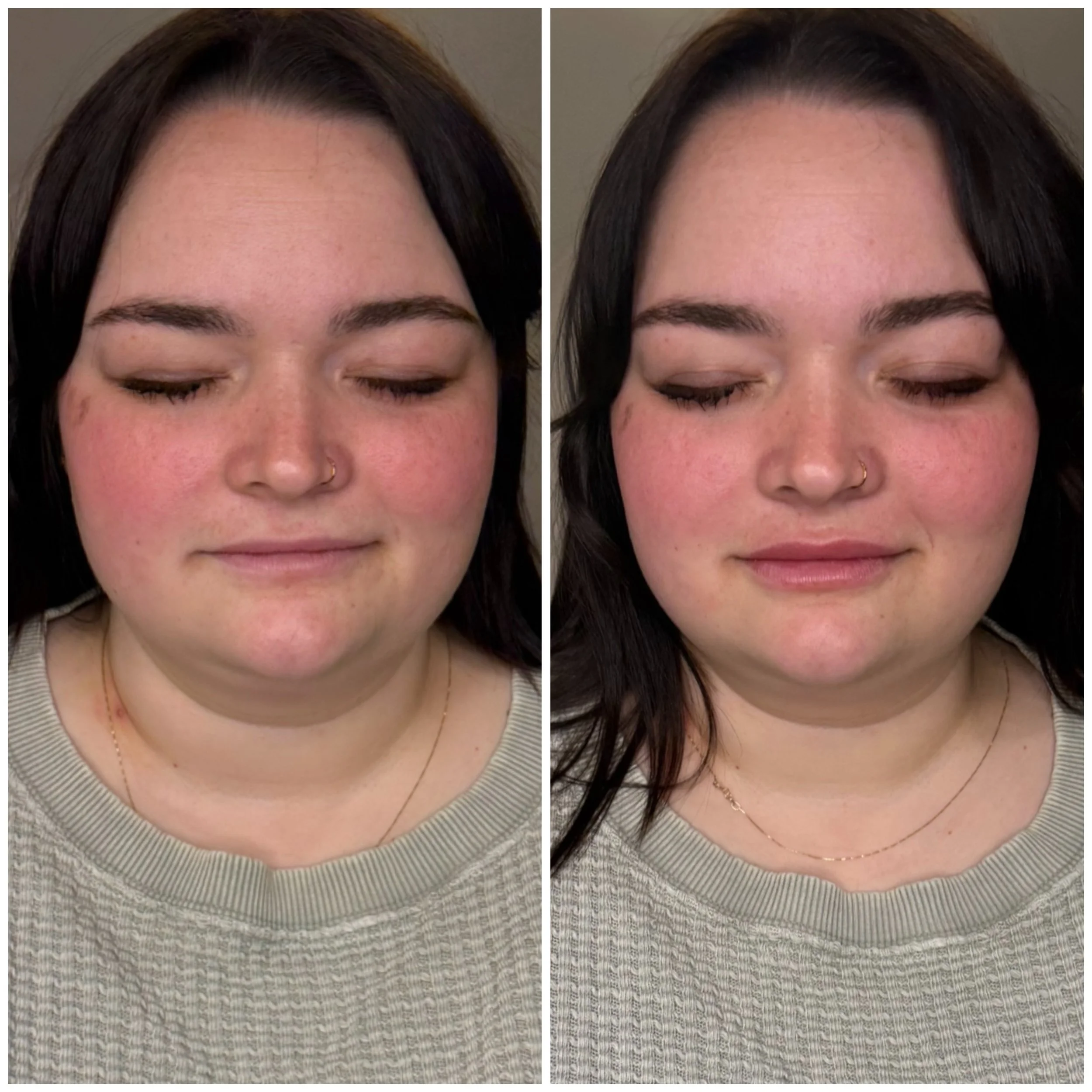 Half a syringe, a subtle difference&hellip; but the kind that brings balance, softness, and confidence back to the whole face 🤍💉

This is your reminder that lip filler does not have to look overdone to make an impact. A half syringe can be the perf