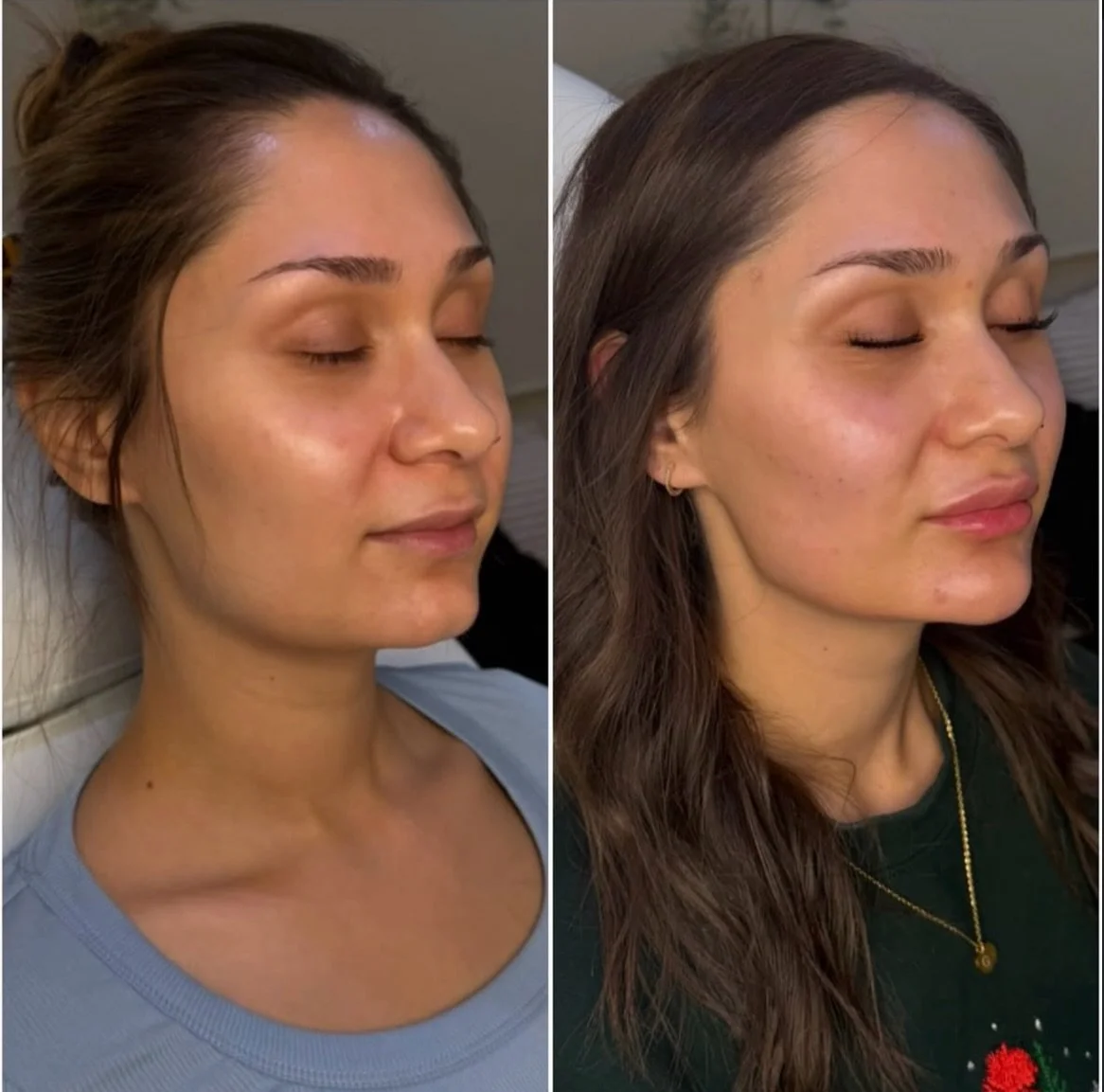 Facial balancing is one of those treatments that&rsquo;s hard to explain until you see it. 👏

None of these clients look &ldquo;done.&rdquo;
Nothing looks overfilled or unnatural.
They still look like themselves&hellip; just more balanced, refreshed