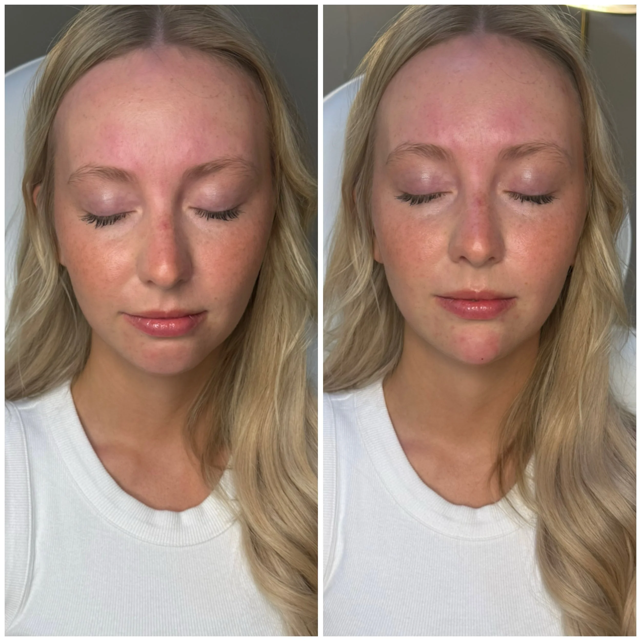 Chin filler: the subtle treatment that can make a BIG difference. 👏

This beautiful before &amp; after shows how adding a small amount of filler to the chin can help create better facial balance, improve profile harmony, and give the lower face a mo
