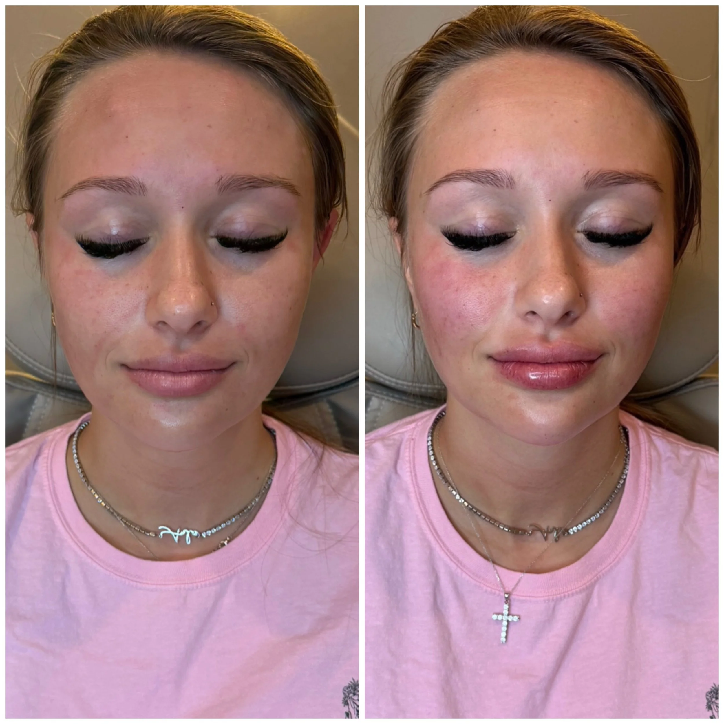 💗 This beautiful mama wanted a refreshed, balanced look while still looking completely like herself. 

The best part? Nothing looks overdone. Just a more rested, confident, and refreshed version of herself. 🤍

💉 Lips for soft volume and hydration
