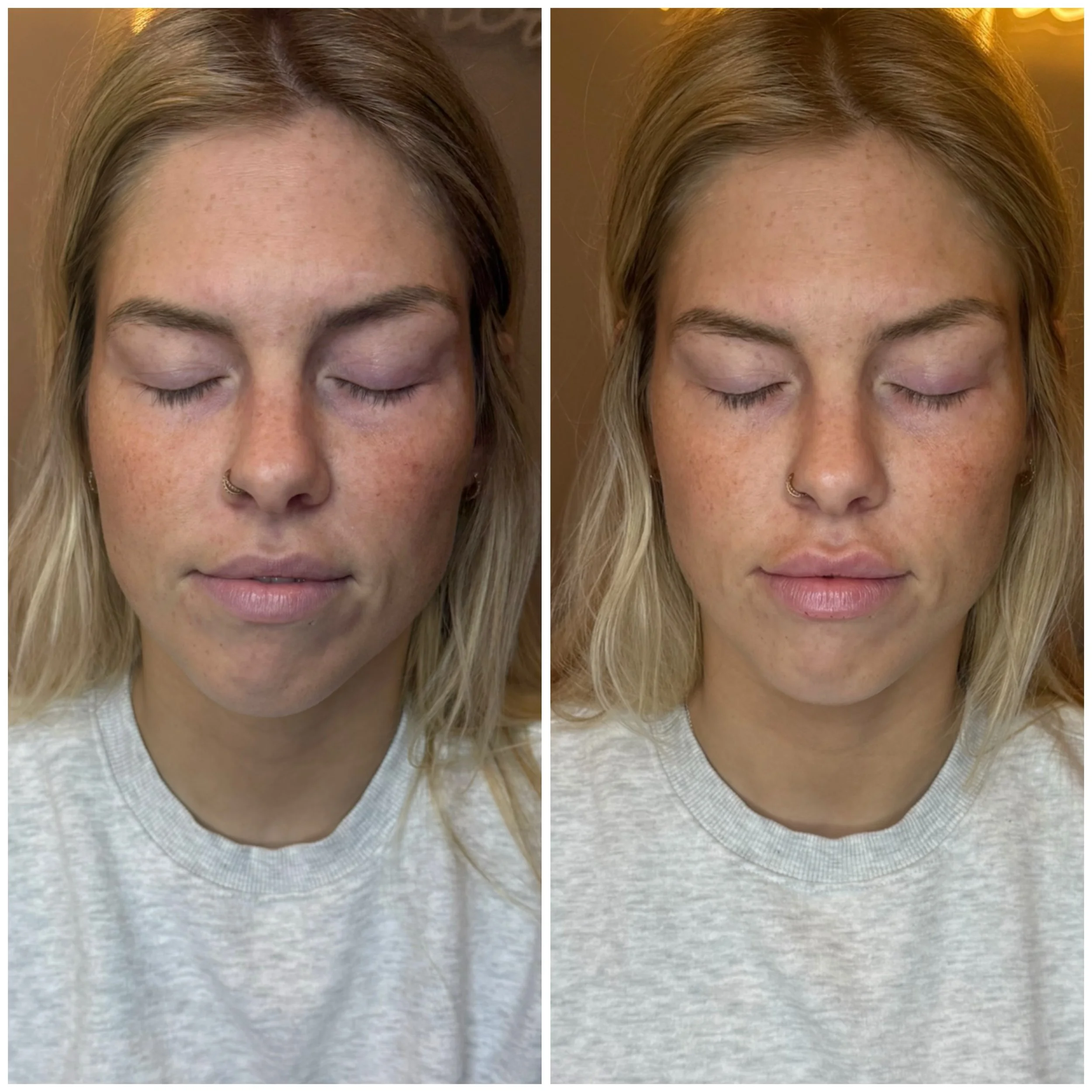 Half a syringe. 🤍

This beautiful client received just 1/2 syringe of lip filler to enhance her natural shape, improve hydration, and add a subtle touch of volume&mdash;without looking &ldquo;done.&rdquo;

✨ Soft enhancement
✨ Improved symmetry
✨ Na