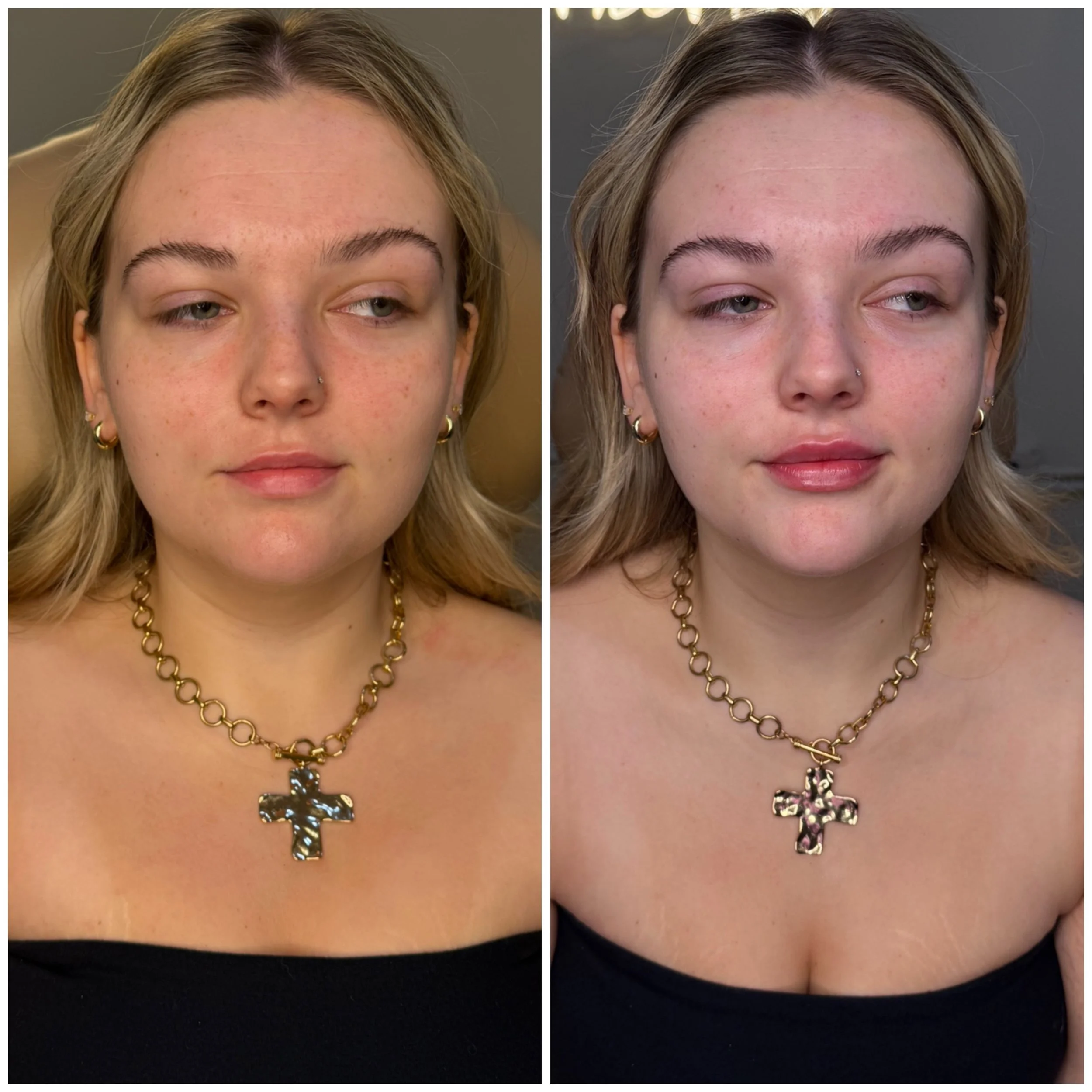 Lip filler doesn&rsquo;t have to look like &ldquo;lip filler.&rdquo; 👄

The goal is hydration, structure, and balance&mdash;not just volume. This beautiful result enhanced her natural shape while keeping everything soft and proportional.

#lipfiller