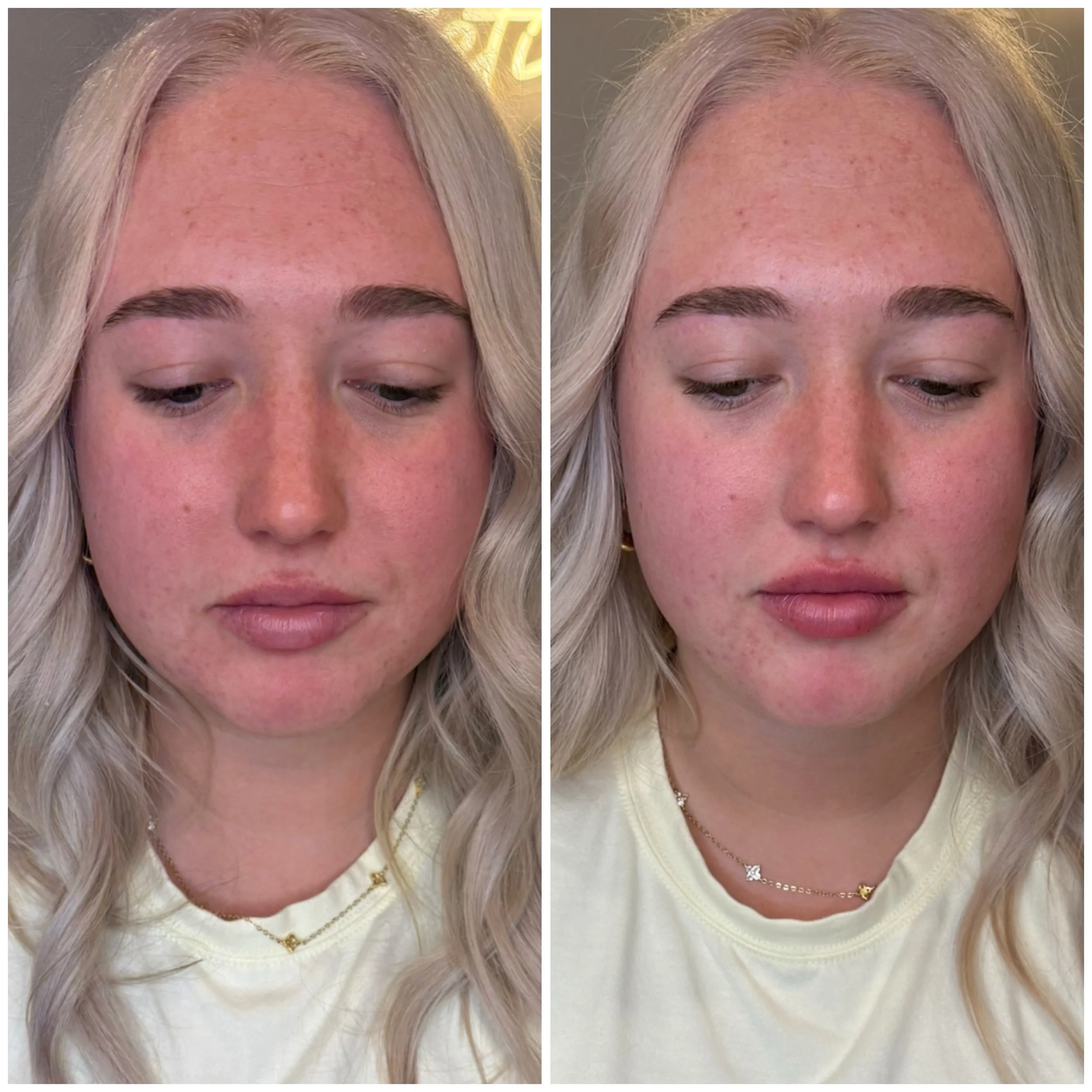 This gorgeous client wanted a subtle enhancement that looked natural, balanced, and effortless. With just &frac12; syringe of filler, we were able to add hydration, improve shape, enhance definition, and create a little extra volume while still keepi