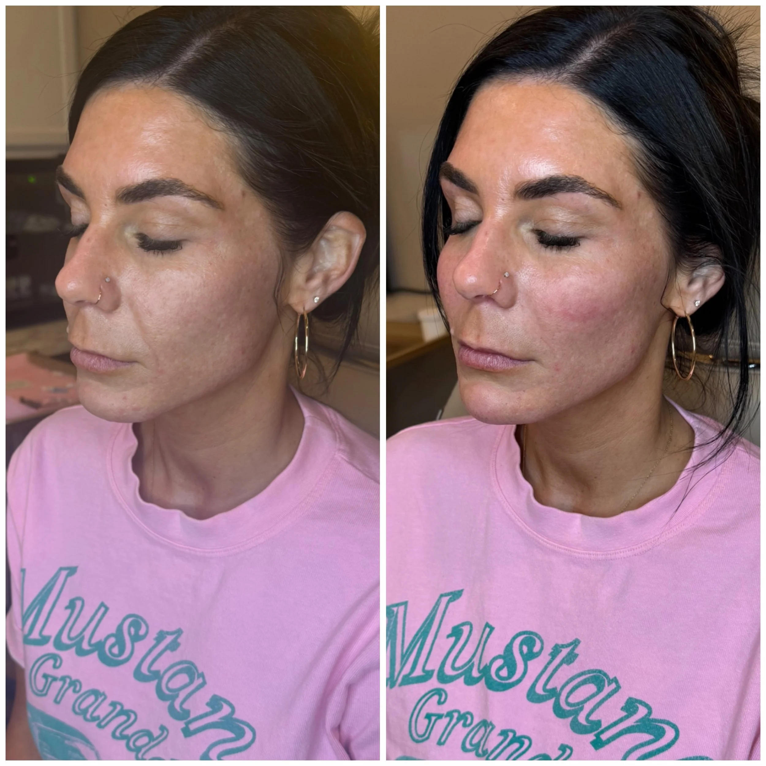 Cheeks + Chin = the ultimate facial balancing duo ✨

A little support in the midface and a touch of chin projection can completely transform facial harmony&mdash;without looking overfilled. Natural, refreshed, and beautifully balanced. 🤍

For this t