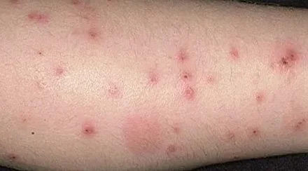red bite spots scattered on lower leg, often seen with flea bites