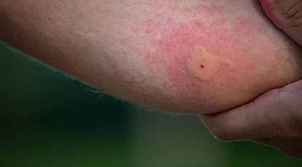 Swollen red patch with a single central bite point, typical of a mosquito bite reaction