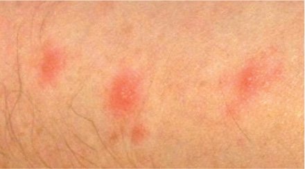 bed bug bites in a line of 3, known as breakfast, lunch and dinner lines.