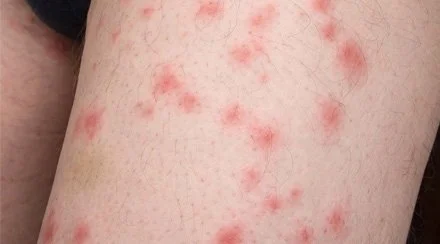 Multiple red bite clusters on a leg, consistent with bed bug bites and skin irritation