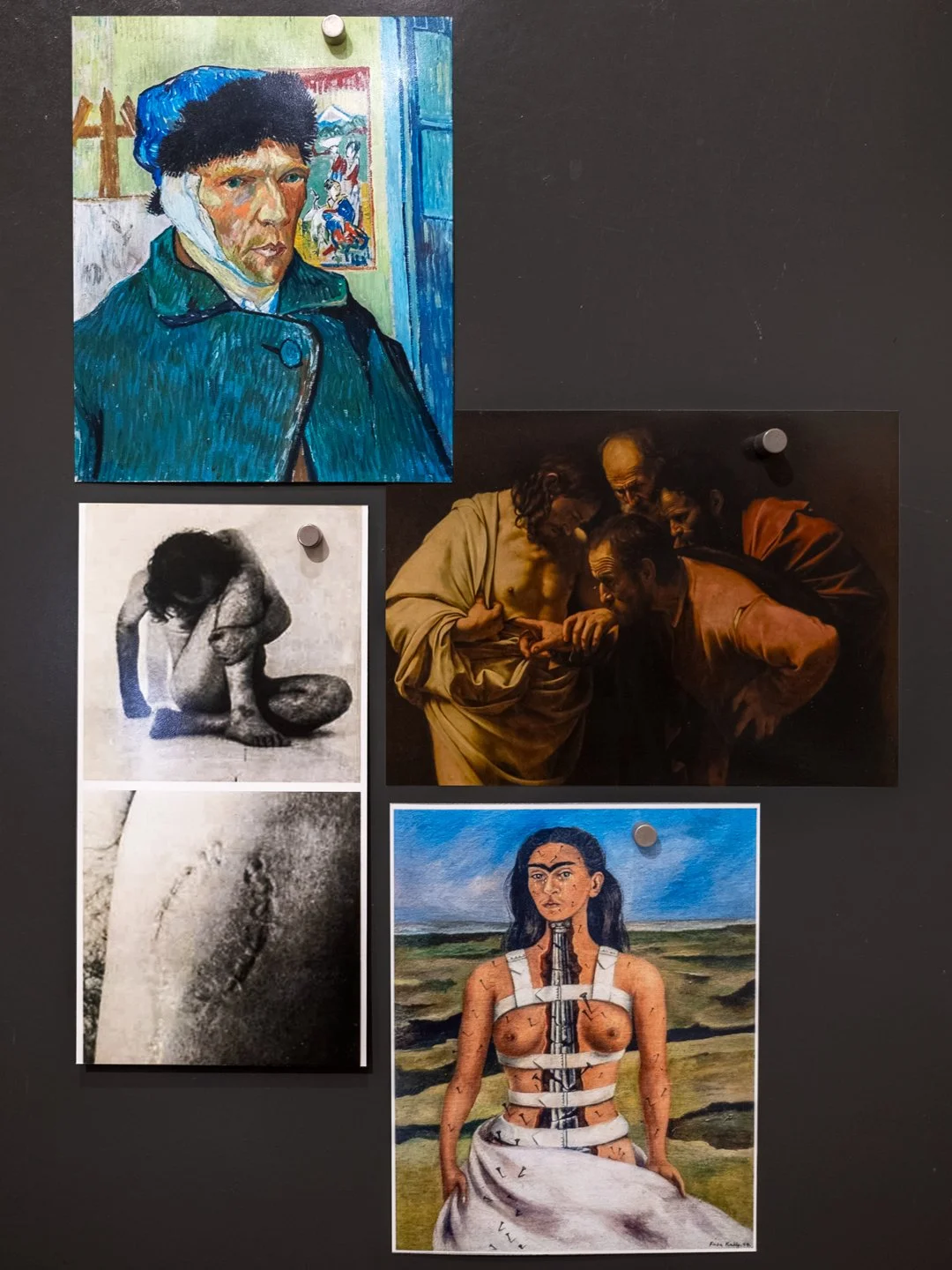 Self Portrait with Bandaged Ear, Vincent van Gogh  Bite, Vito Acconci  The Incredulity of Saint Thomas, by Caravaggio  The Broken Column, Frida Kahlo