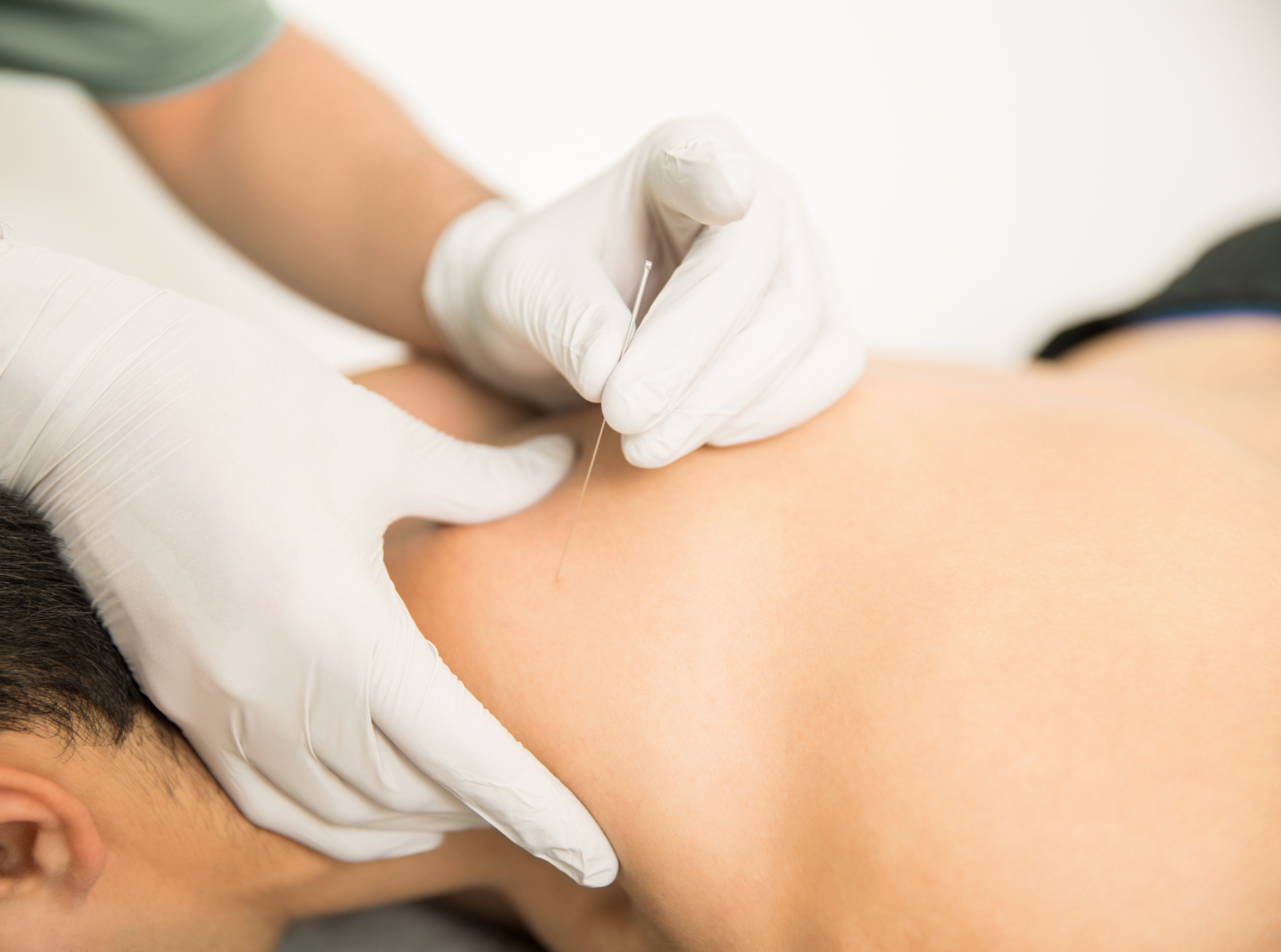 Dry Needling: Evidence-Based Relief for Muscle Pain and Trigger Points