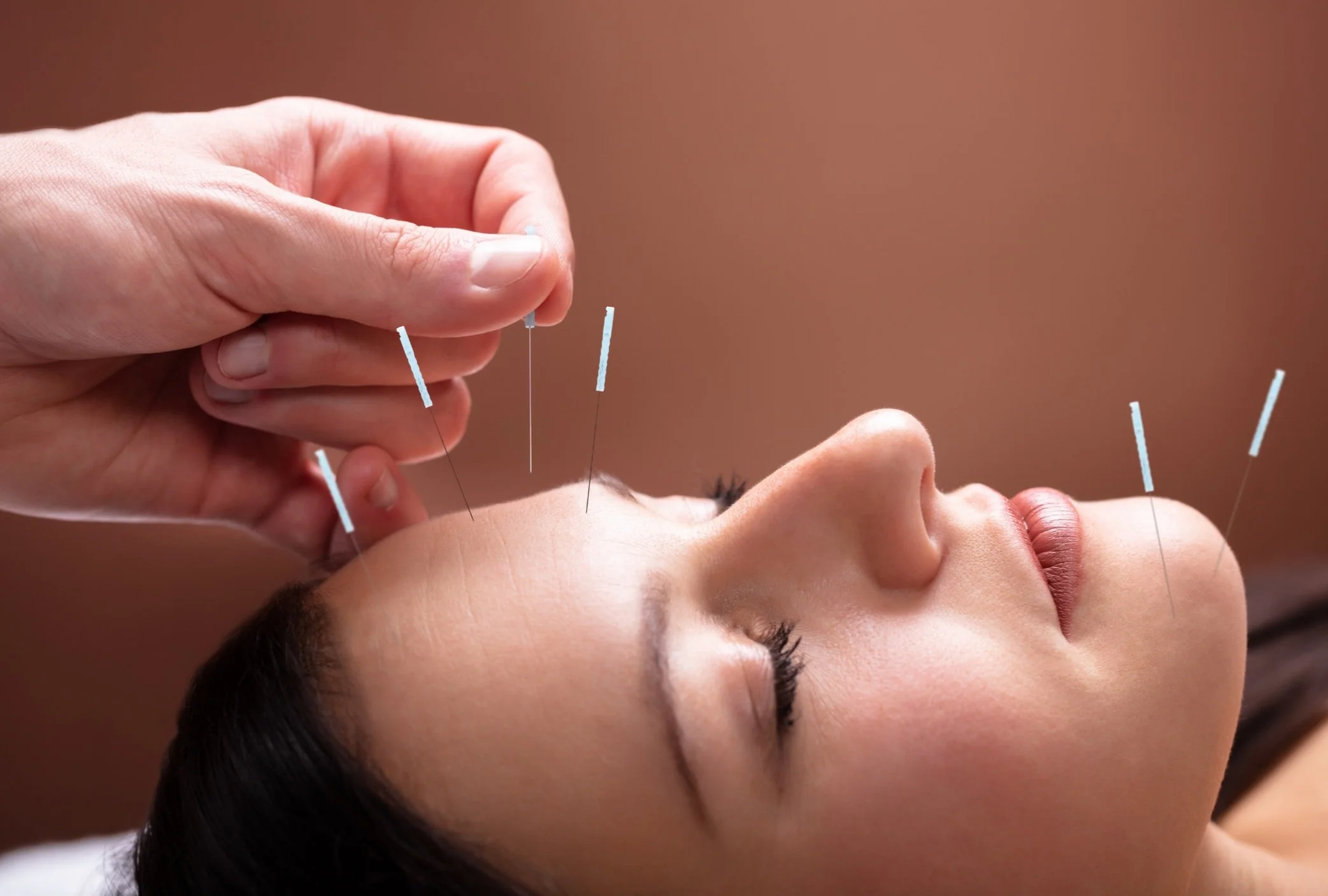 A woman receiving acupuncture treatment with needles inserted into her face.