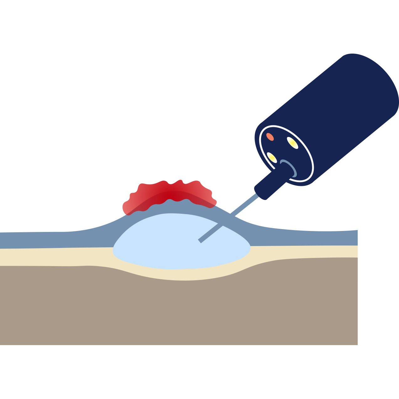 Endoscopic Submucosal Dissection (ESD) Melbourne — Dr Shane Selvanderan ...