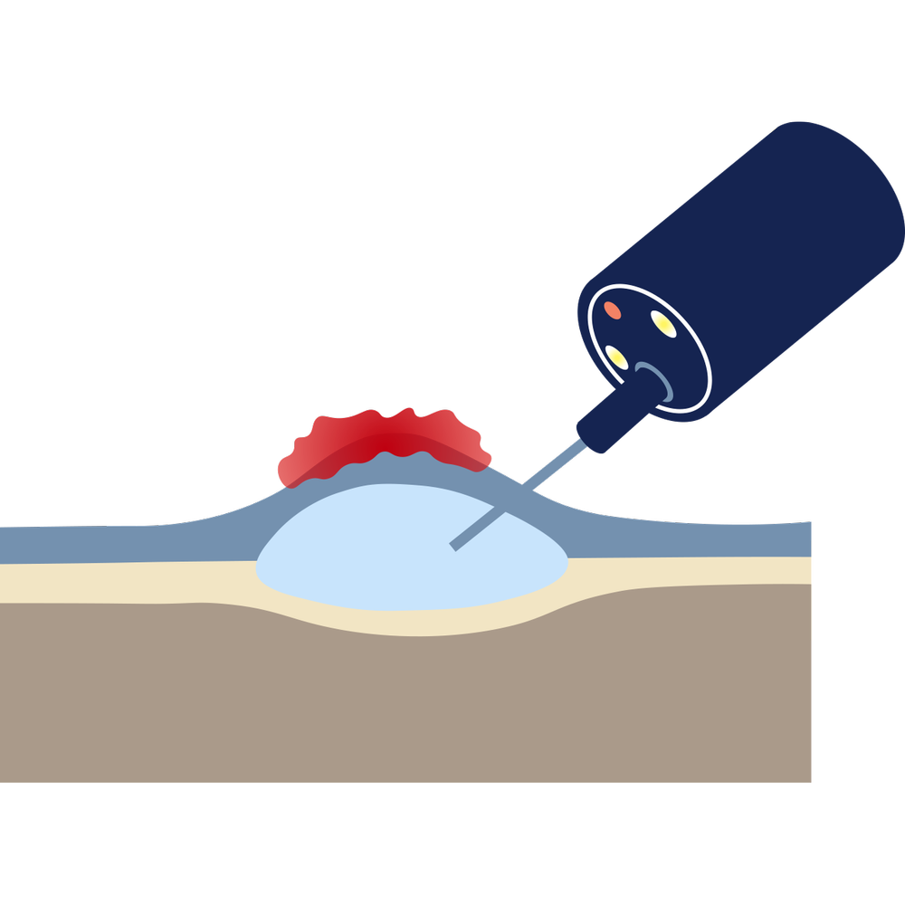 Endoscopic Submucosal Dissection (ESD) Melbourne — Dr Shane Selvanderan ...