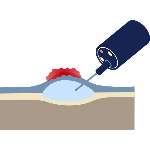 Endoscopic Submucosal Dissection (ESD) Melbourne — Dr Shane Selvanderan ...