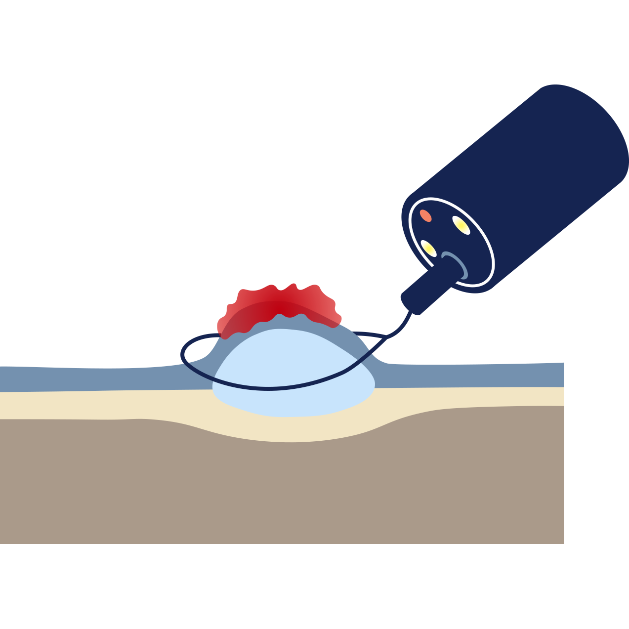 Endoscopic Mucosal Resection (EMR) by Dr Shane Selvanderan Gastroenterology & Endoscopy in Melbourne