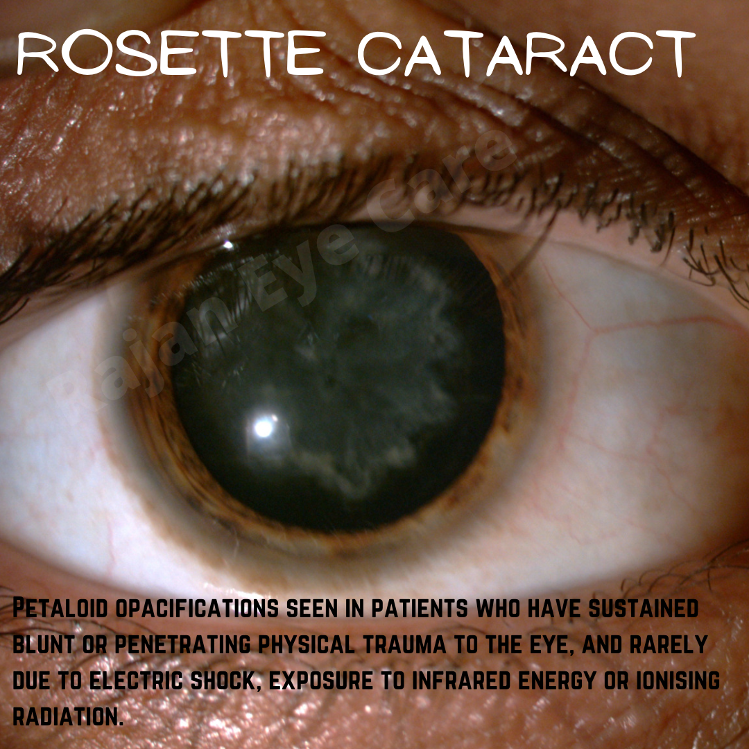 Rosette Cataract — Ophthalmobytes