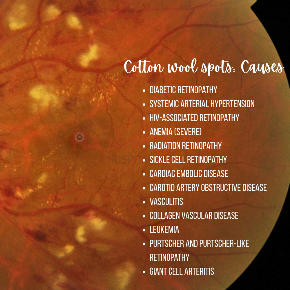 Causes of Cotton Wool Spots — Ophthalmobytes
