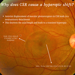 Hyperpic Why does central serous retinopathy cause a hyperopic shift ...