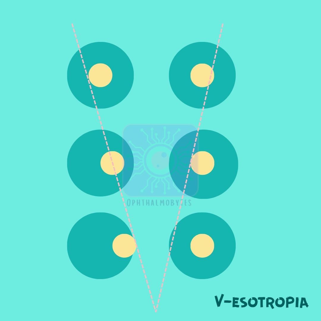 V-Pattern Strabismus — Ophthalmobytes
