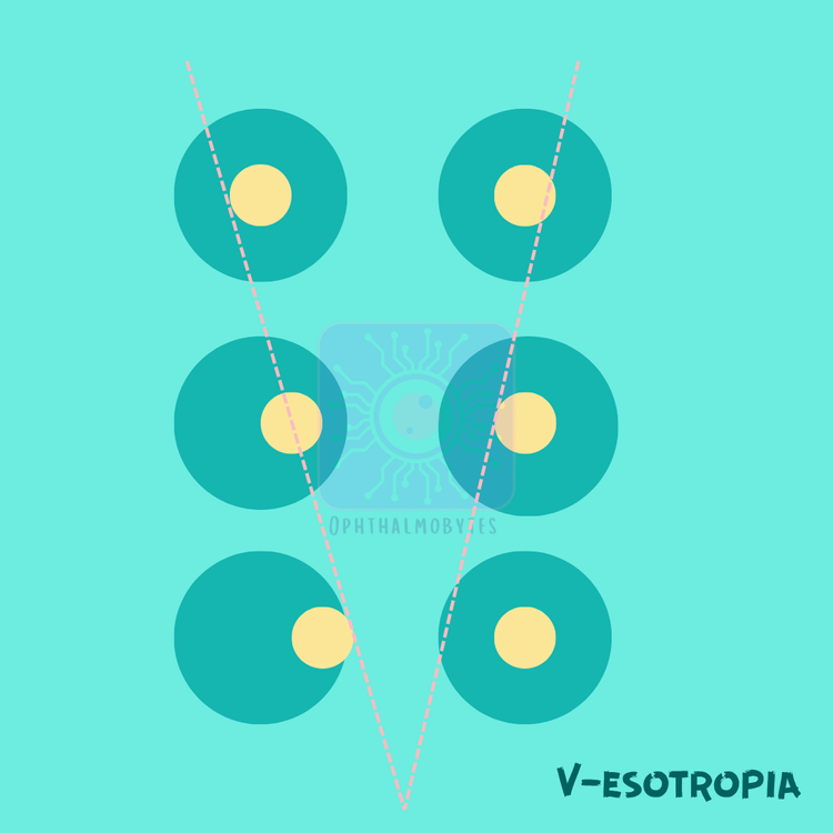 V-Pattern Strabismus — Ophthalmobytes