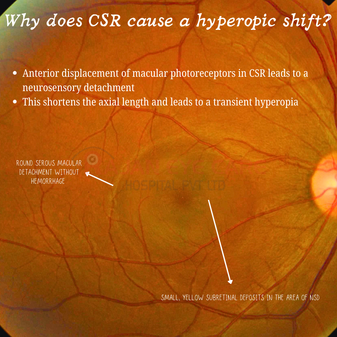 Why does central serous retinopathy cause a hyperopic shift?