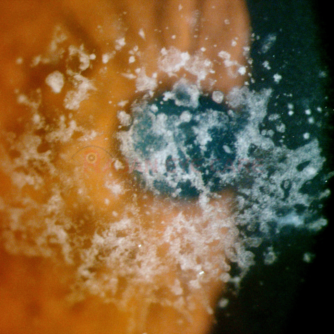 EyeSpy - Granular Dystrophy.png