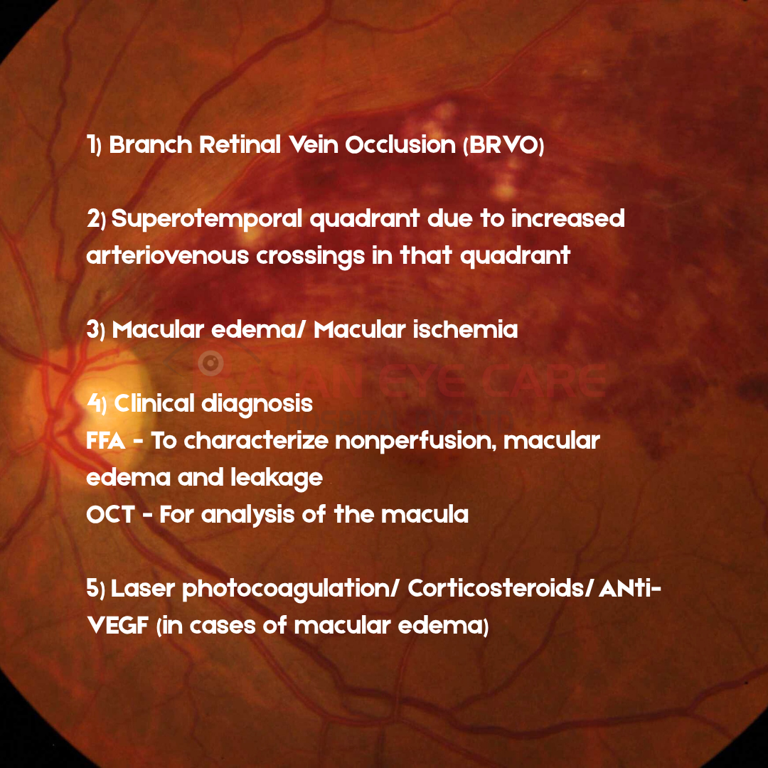 EyeSpy - BRVO answers.png