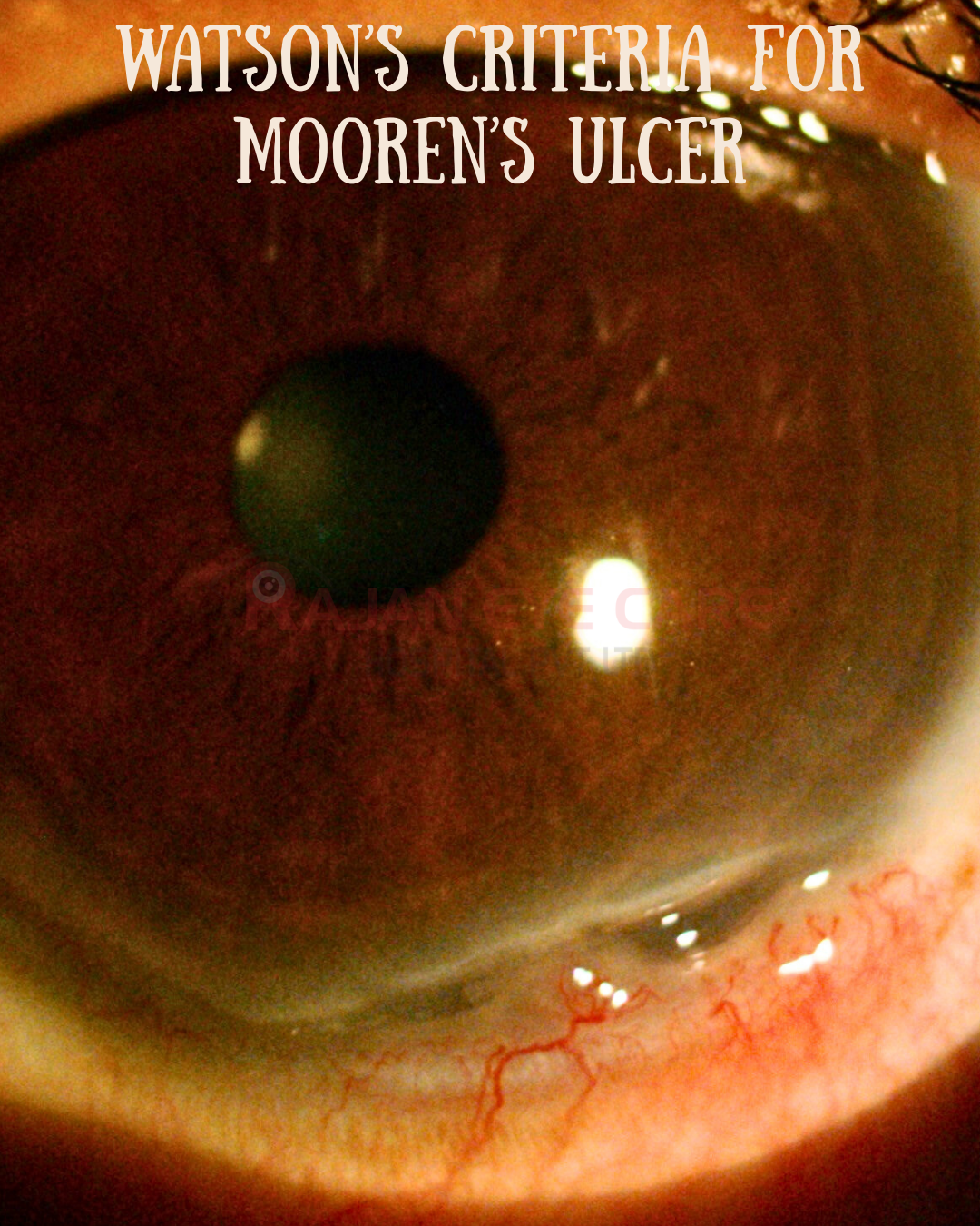 Watson's Criteria of Mooren's Ulcer