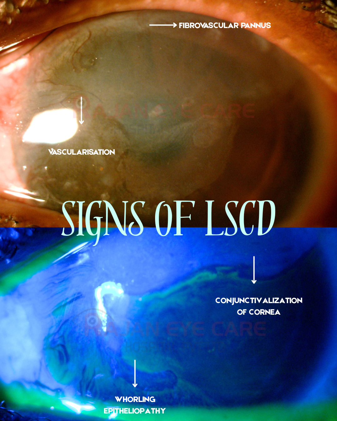 Signs of LSCD