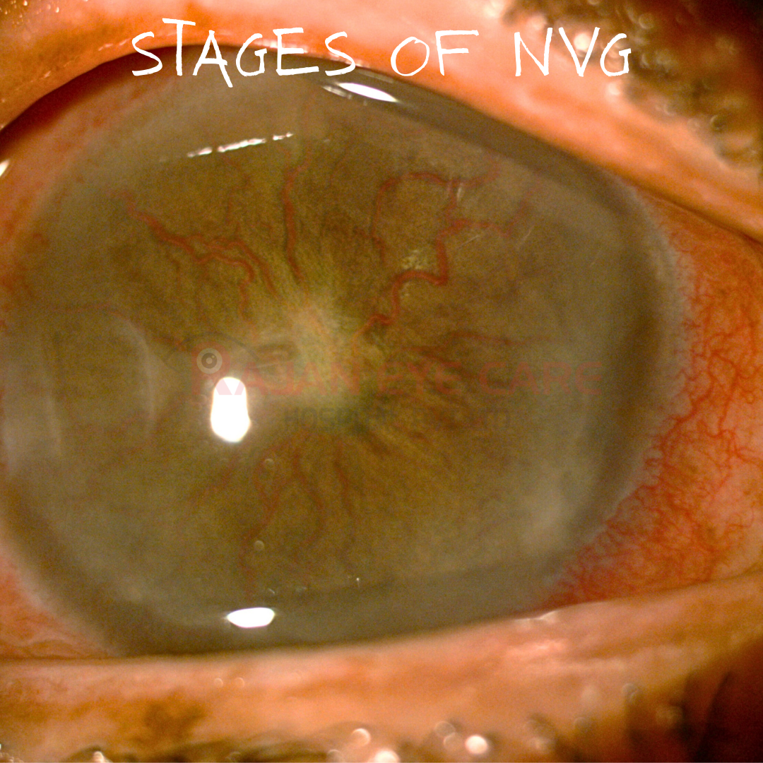Stages of Neovascular Glaucoma