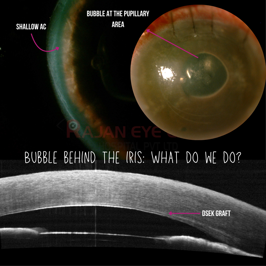 Bubble behind the iris: What do we do?