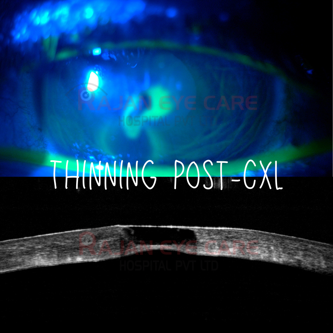 Thinning Post-CXL: How was it managed?