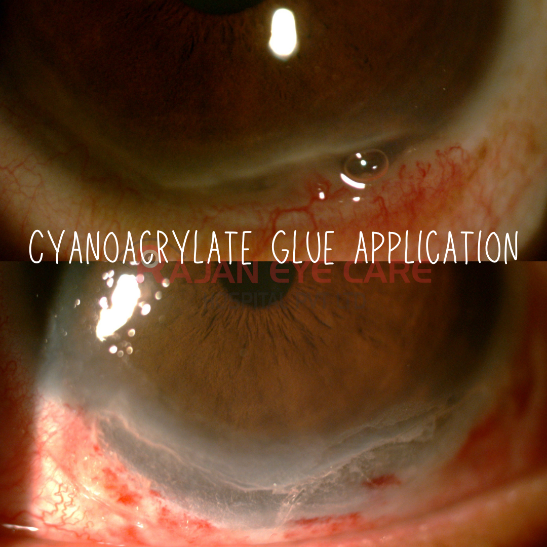 Cyanoacrylate Glue – Practical Tips