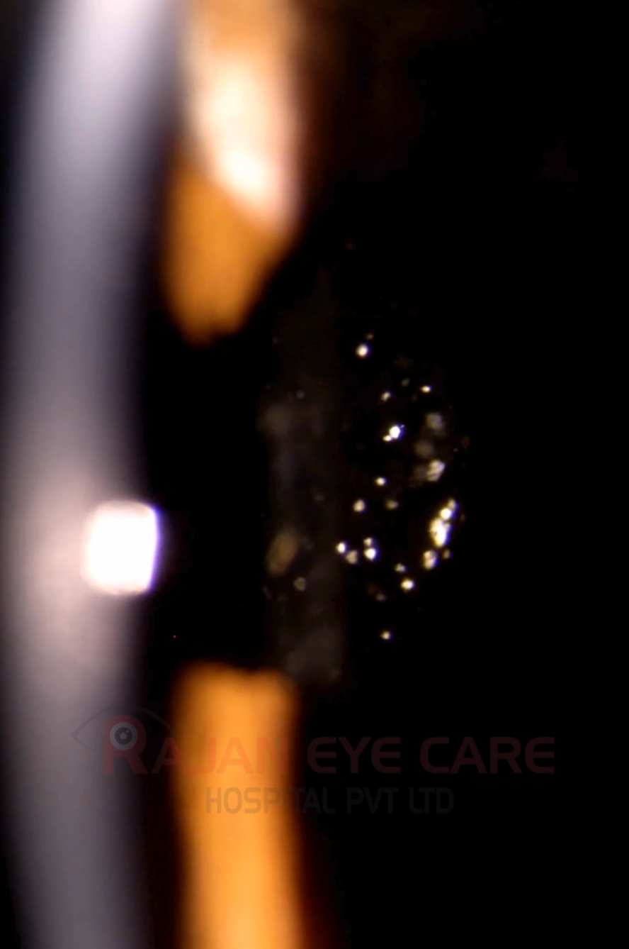 Video: Incidental finding of Asteroid Hyalosis 