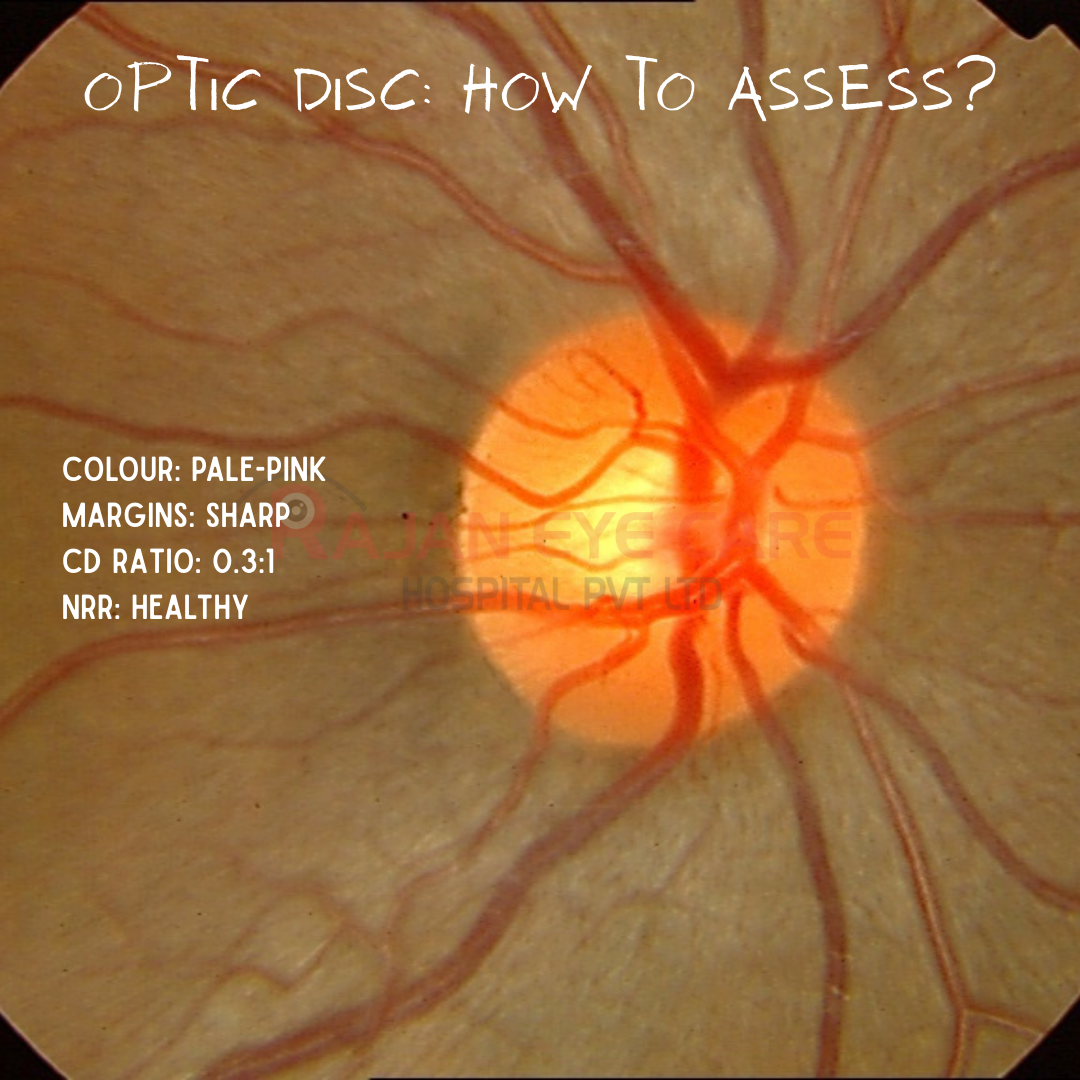 Optic Disc: How to assess?